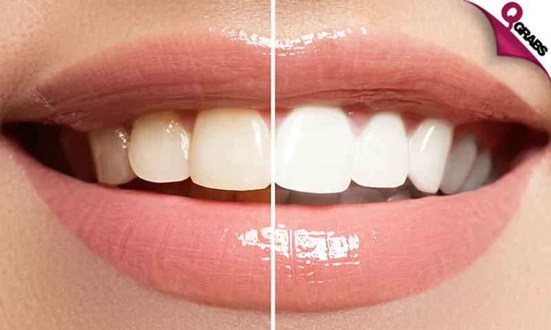 In-Office Zoom Teeth Whitening!